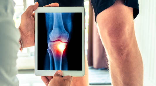 Digitale Röntgenaufnahme zeigt Kniearthrose – entzündlicher Verschleiß im Kniegelenk sichtbar auf Tablet, ärztliche Diagnose bei Gelenkschmerzen und Bewegungseinschränkungen
