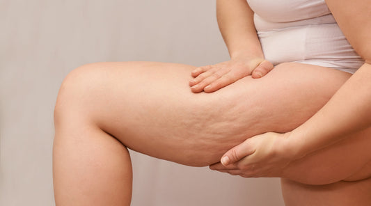 Frau zeigt Cellulite an Oberschenkeln zur Veranschaulichung von Hautbildveränderungen